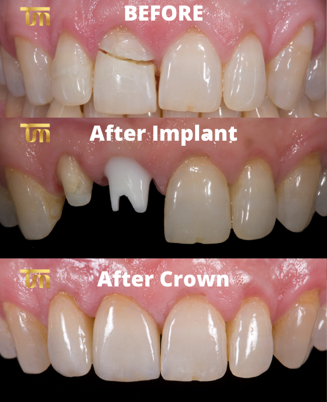 Crowns Vs Porcelain Veneers Vs Dental Implants And When To Use Which